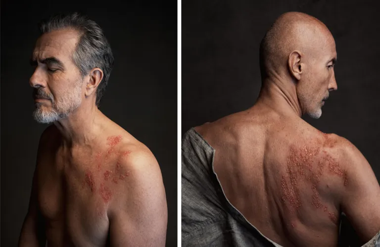 The Virus That Never Left: Week of Action for Shingles Calls on Cypriot Adults to Act